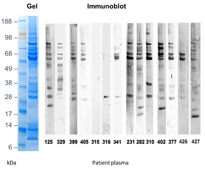 Electrophoretic separation of proteins (molecular weights indicated by kDa-marker) and immunoblot with plasma from different patients showing that patient antibodies react to different proteins with different intensities. Photo: Christiane Fæste